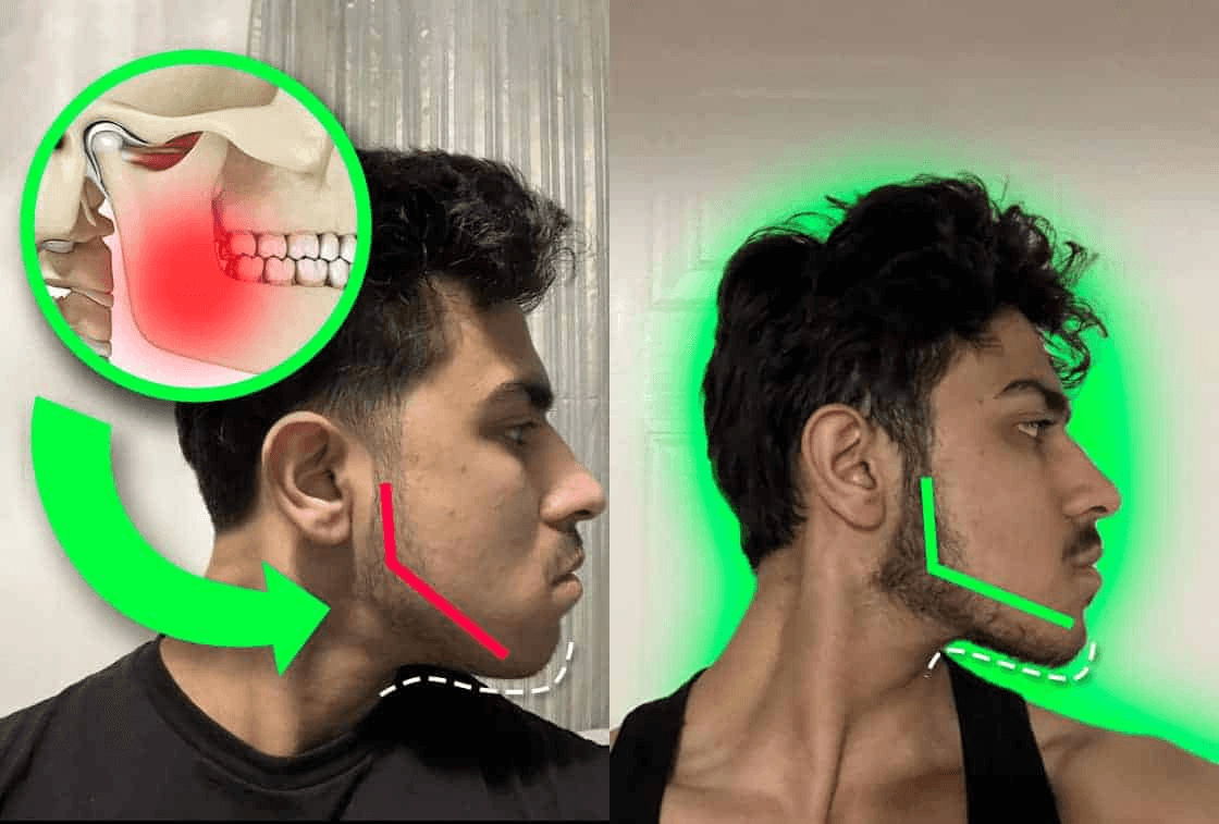 Jawzrsize vs. Mewing: Which One Works Better for a Defined Jawline?